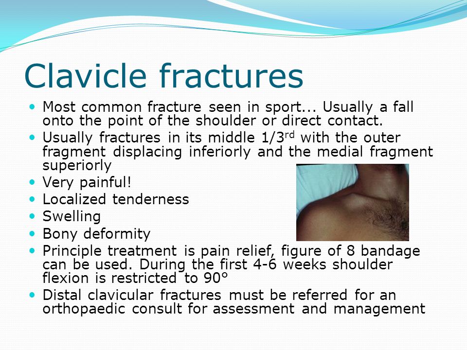 Clavicle fractures Most common fracture seen in sport... Usually a fall onto the point of the shoulder or direct contact.
