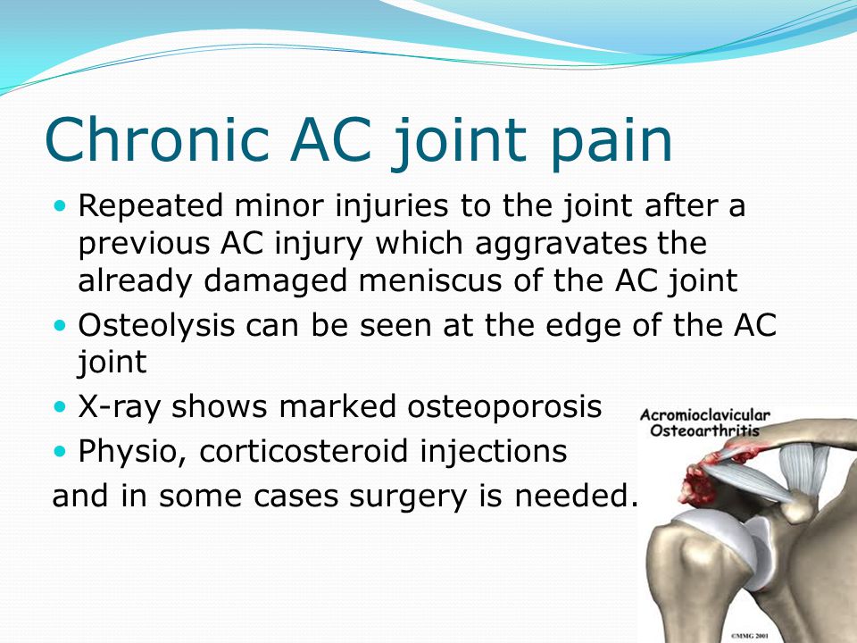 Chronic AC joint pain Repeated minor injuries to the joint after a previous AC injury which aggravates the already damaged meniscus of the AC joint.