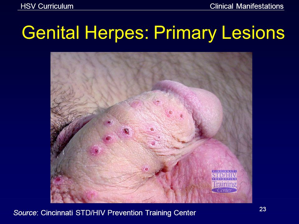 Genital Herpes: Primary Lesions.