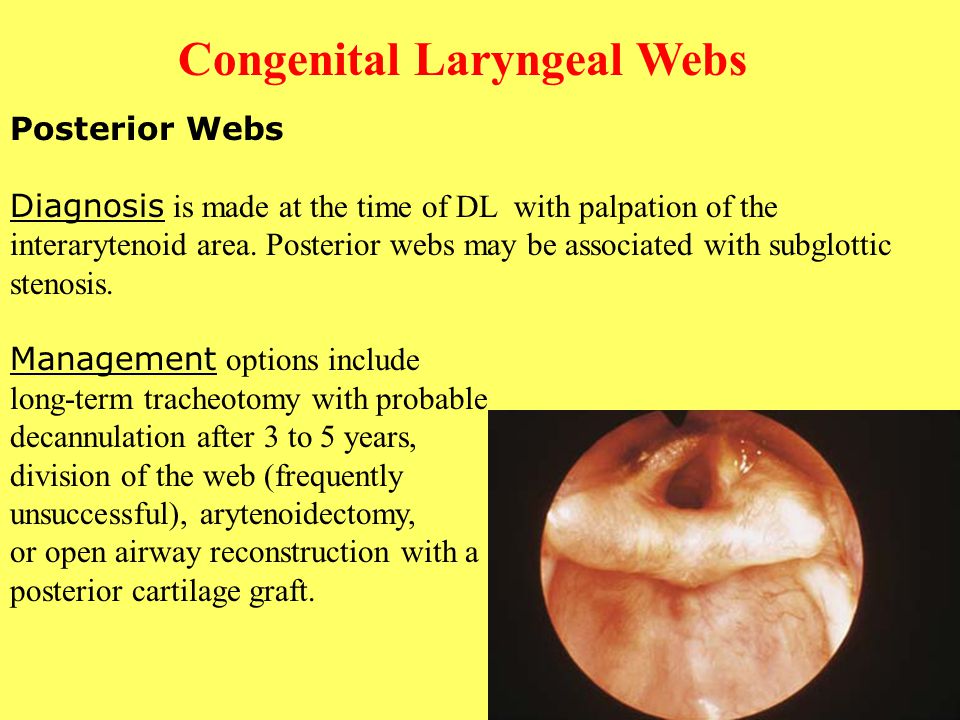 Congenital Laryngeal Webs