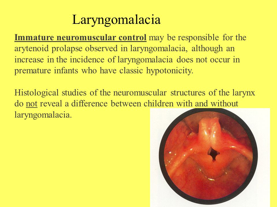 Laryngomalacia