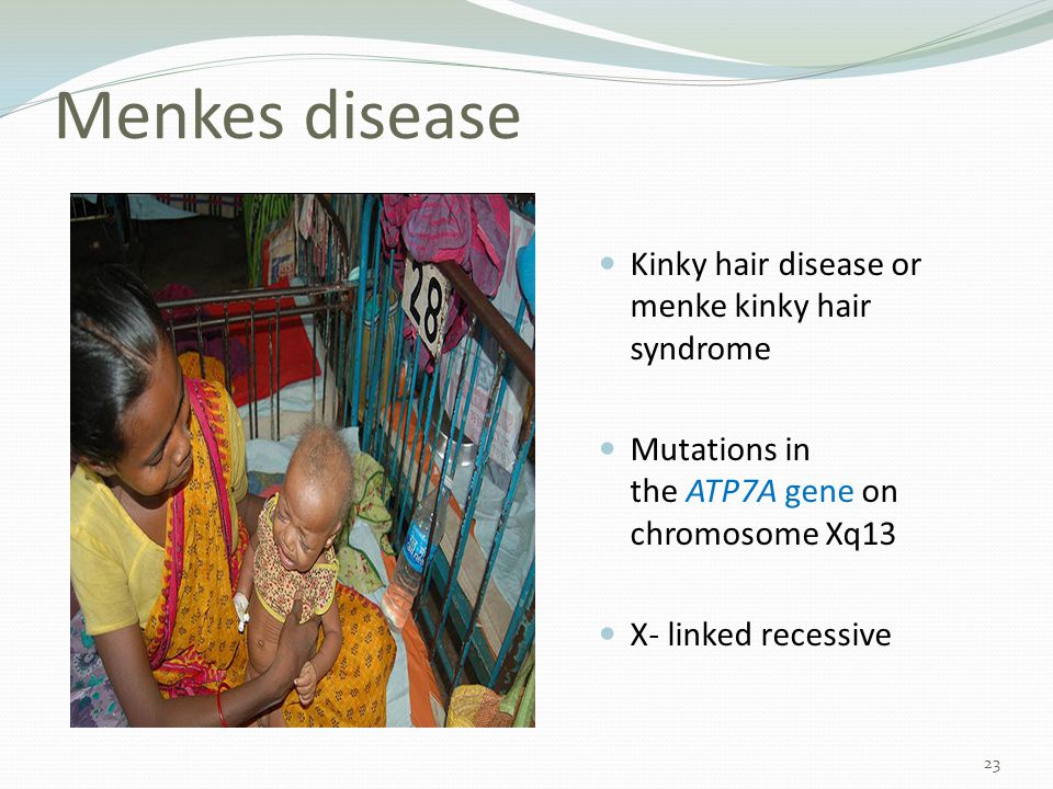 Menkes Kinky Hair Disease