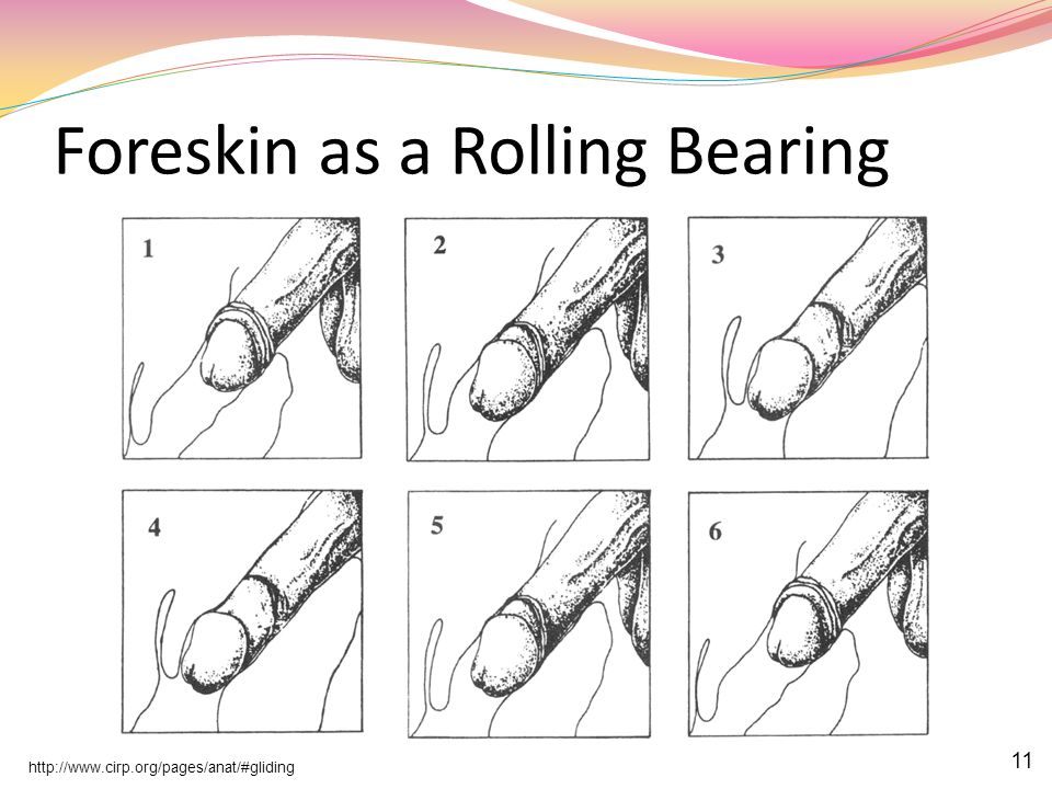 Circumcision and the Foreskin - ppt video online download