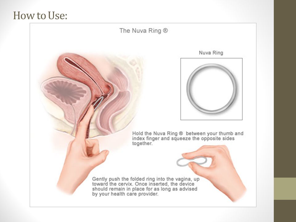 Compare Birth Control Methods Dosing Schedules