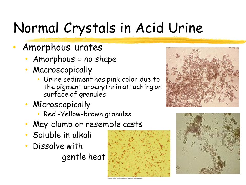 amorphous urates in urine