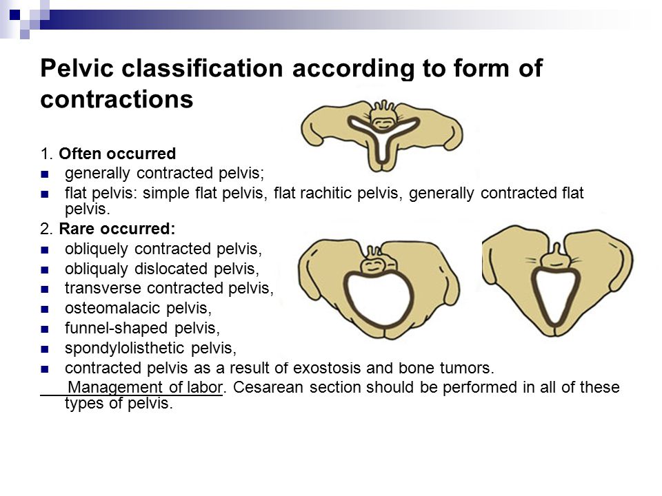 Pelvic classification according to form of contractions.