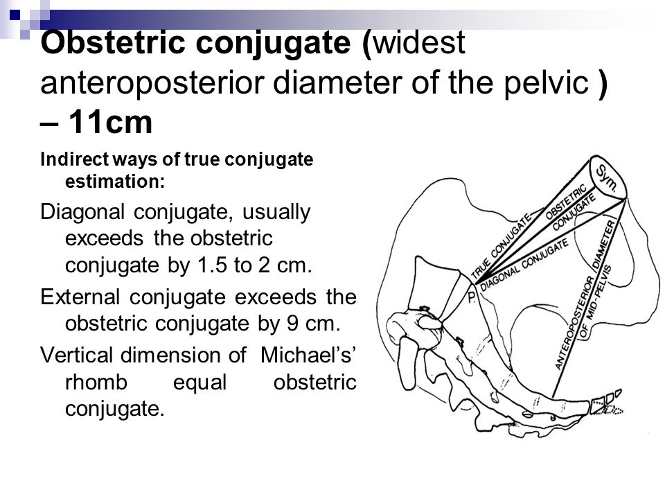 Obstetric conjugate (widest anteroposterior diameter of the pelvic ) - 11cm...