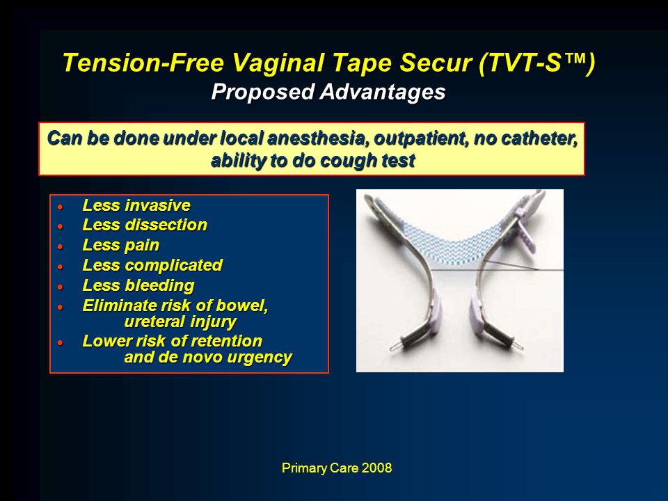 Tvto Or Tvt Sling For Stress Urinary Incontinence