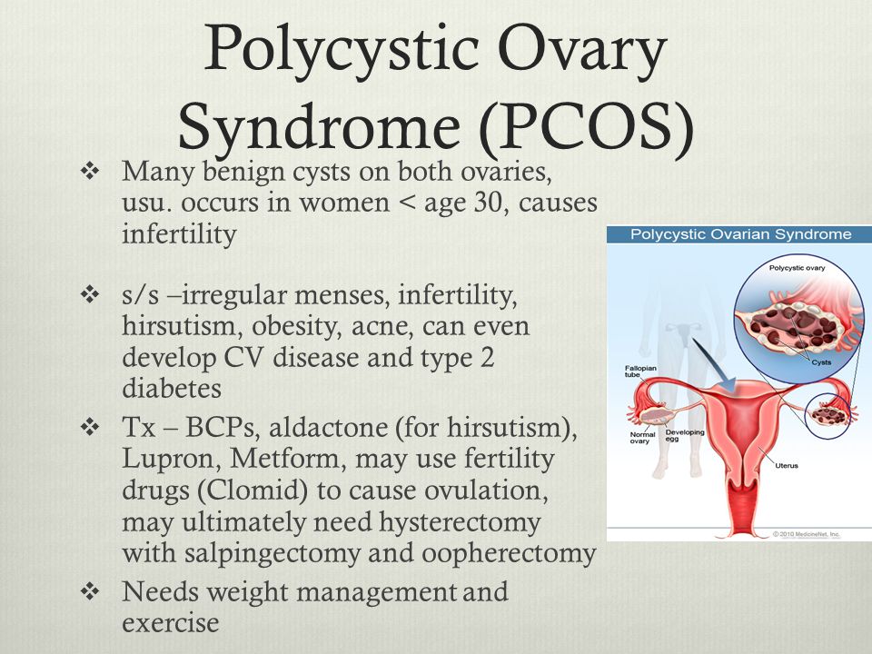 Polycystic Ovary Syndrome (PCOS) .