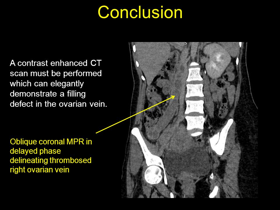 Right Ovarian Vein Thrombosis A Diagnosis That Will Not Go In Vain Ppt Video Online Download