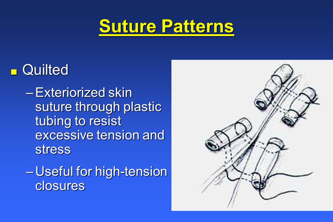 Wound Healing and Suture Knowledge - ppt video online download