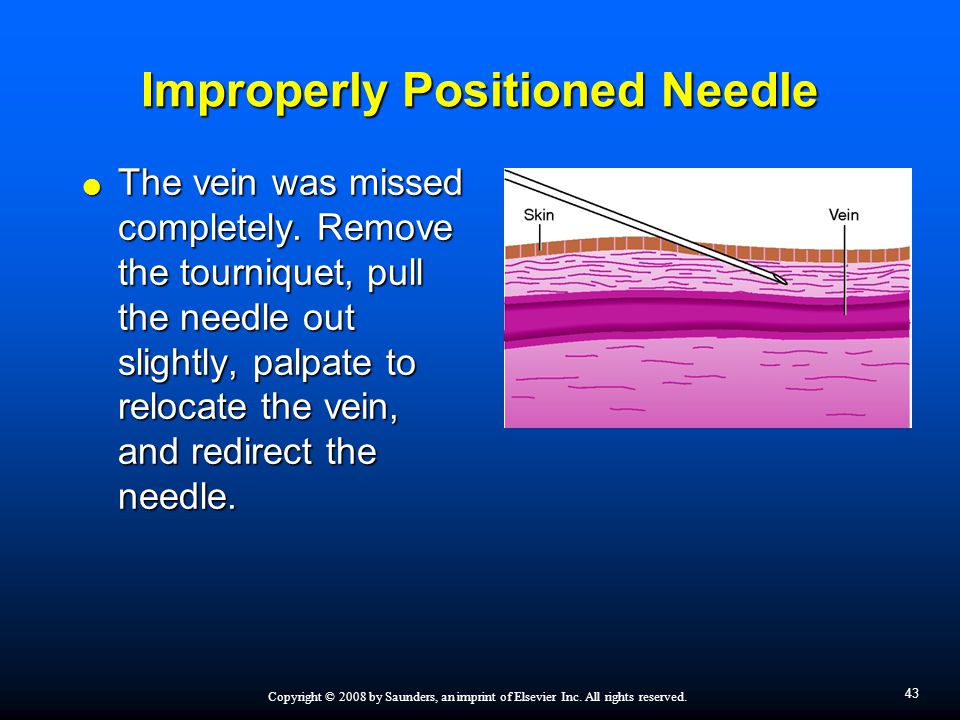 Improperly Positioned Needle