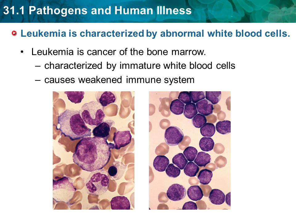 Leukemia is characterized by abnormal white blood cells.