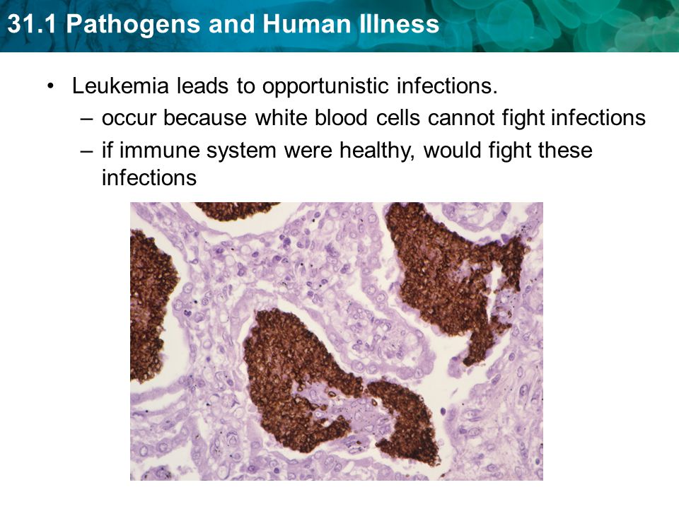 Leukemia leads to opportunistic infections.