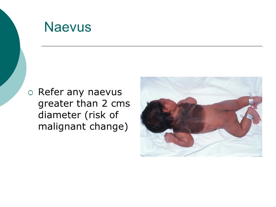 Naevus Refer any naevus greater than 2 cms diameter (risk of malignant change)
