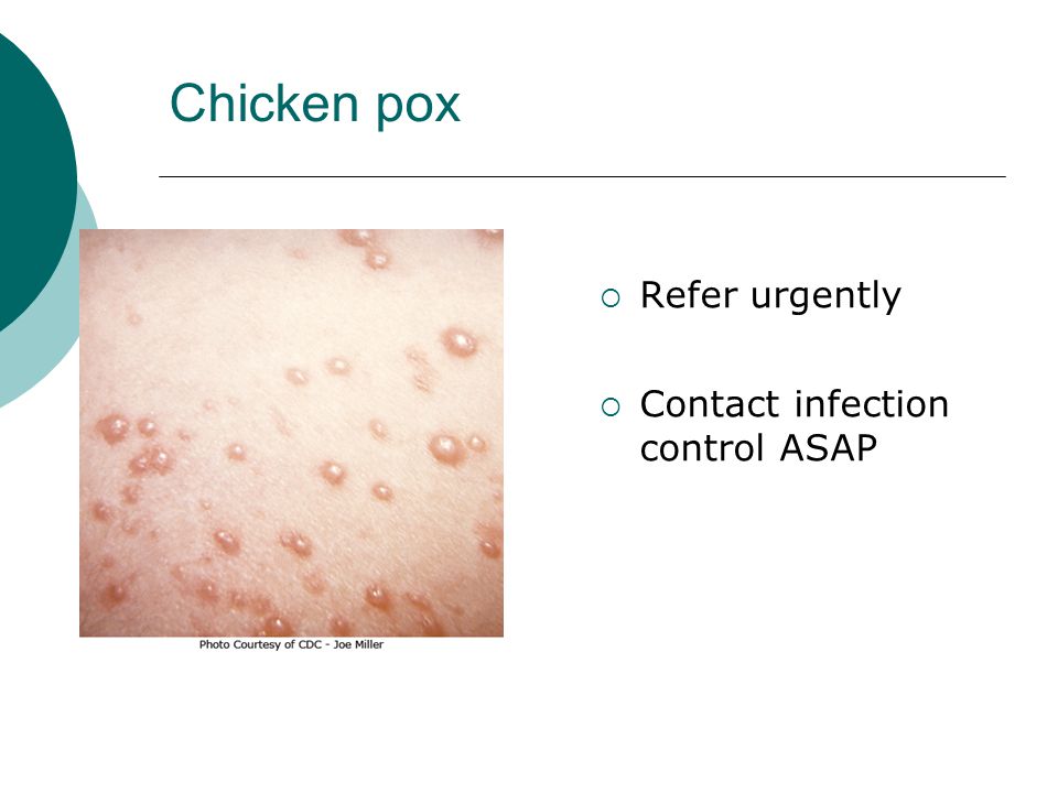 Chicken pox Refer urgently Contact infection control ASAP