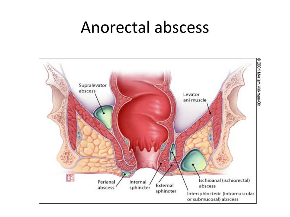 Anal fissure in crohn's disease uc