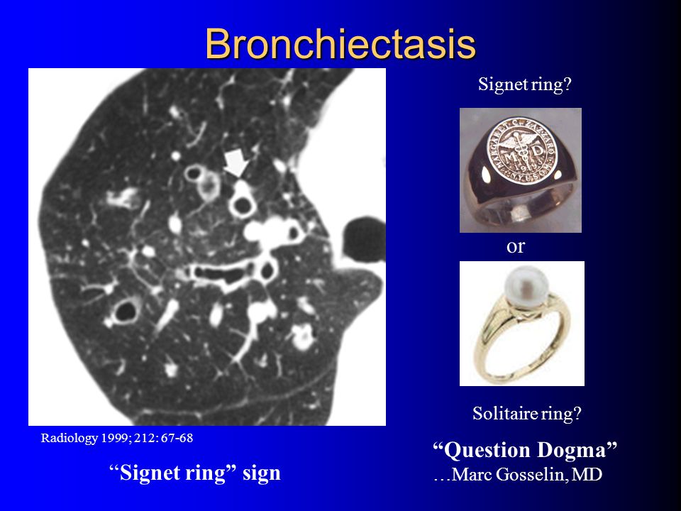 Bronchiectasis - an overview | ScienceDirect Topics