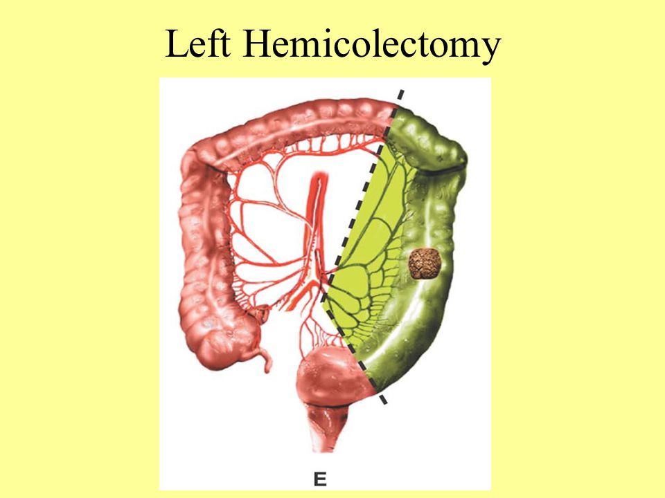 Left Hemicolectomy