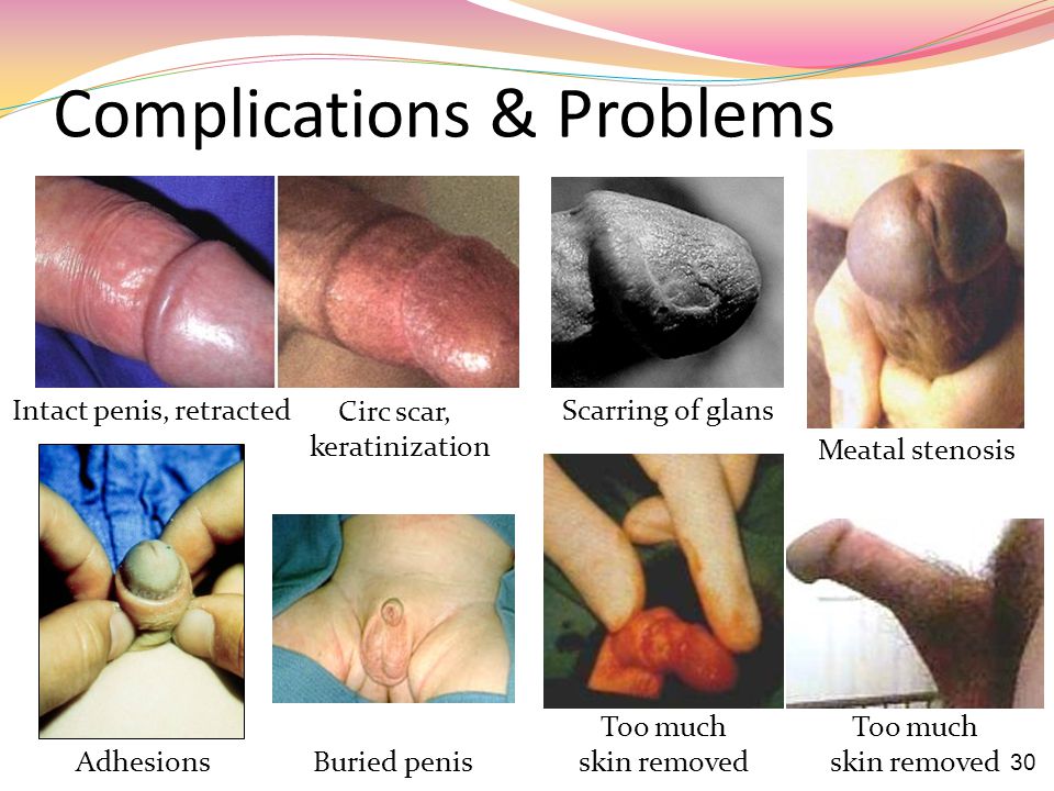 Circumcision and the Foreskin - ppt video online download