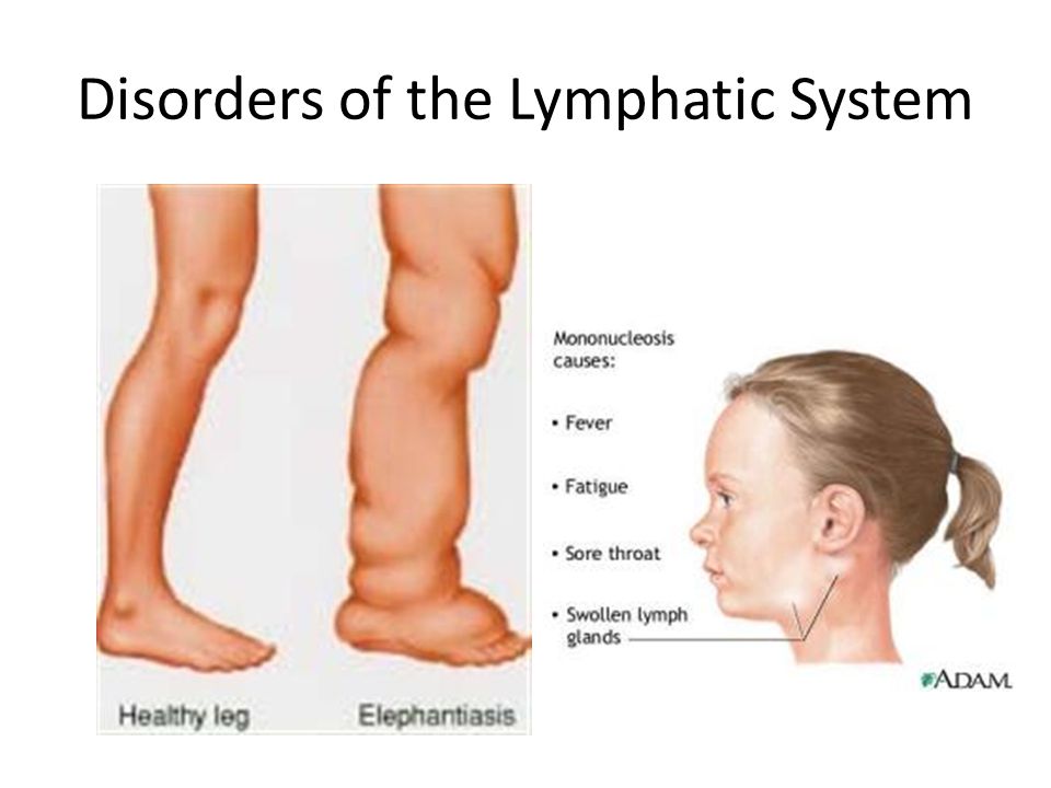 Disorders of the Lymphatic System