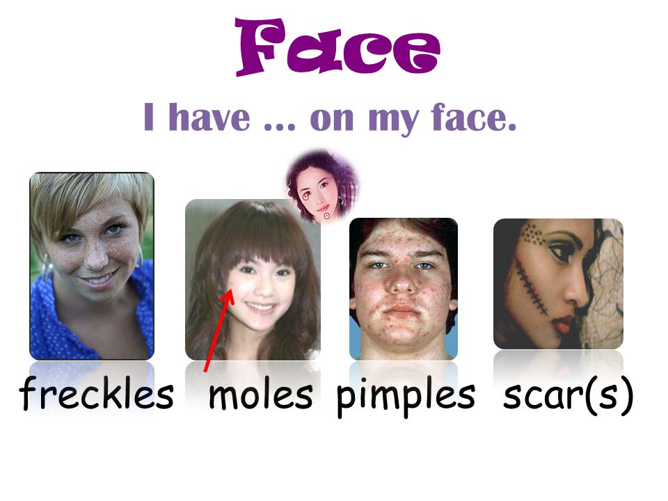 Face I have … on my face. freckles moles pimples scar(s)