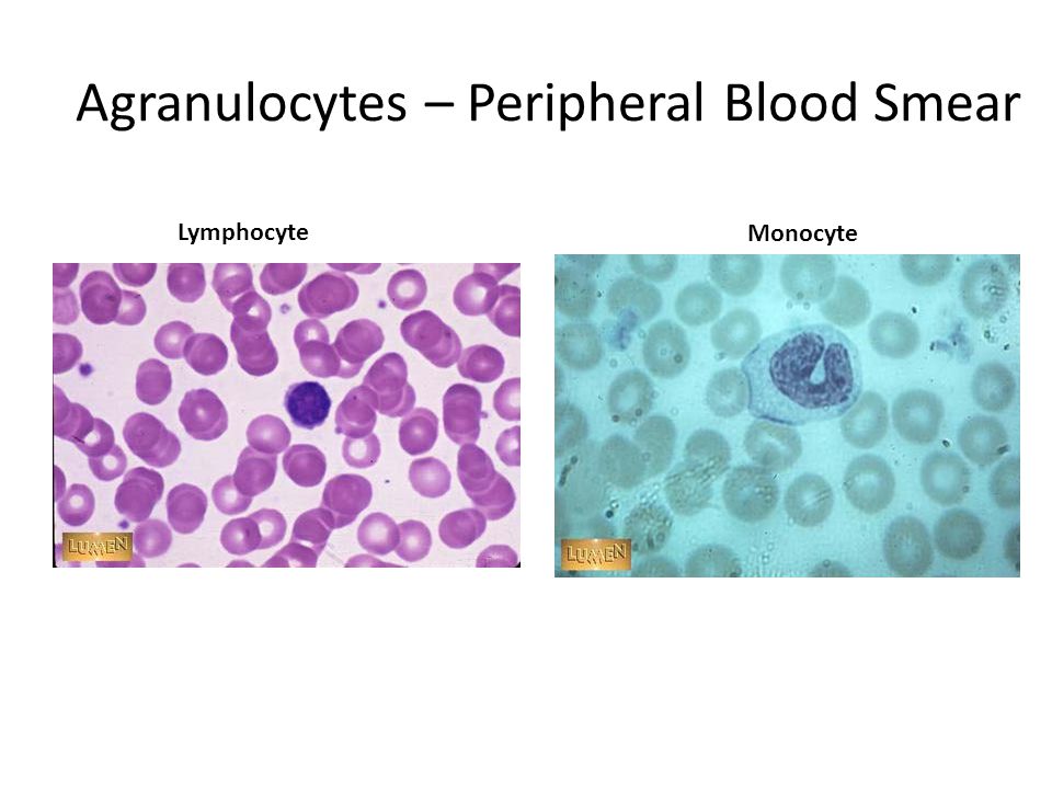 Mature neutrophilia on peripheral blood smear