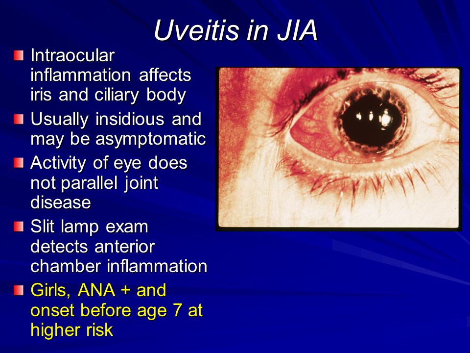juvenile idiopathic arthritis with uveitis