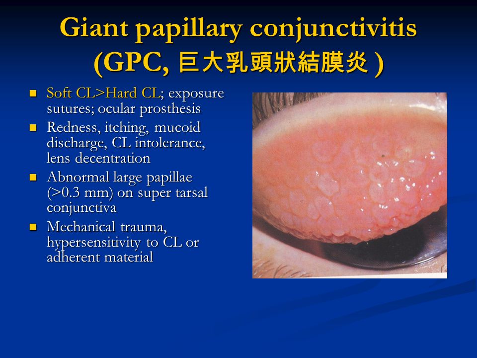giant papillary conjunctivitis treatment