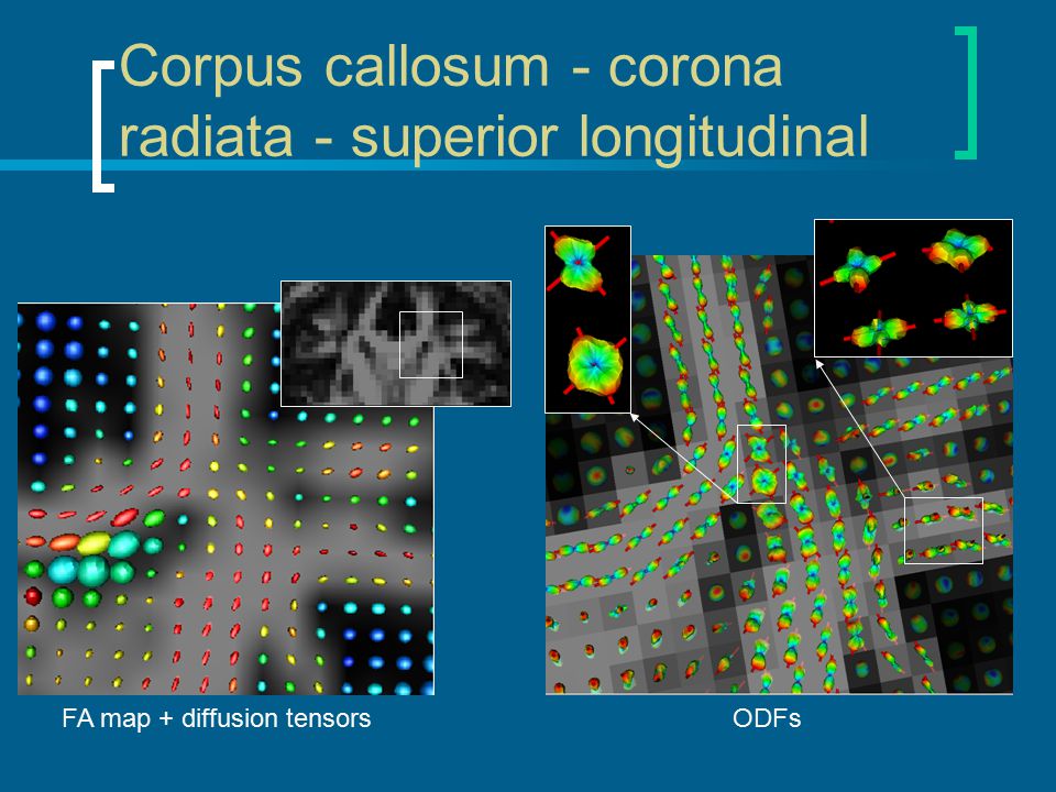 Corpus callosum - corona radiata - superior longitudinal