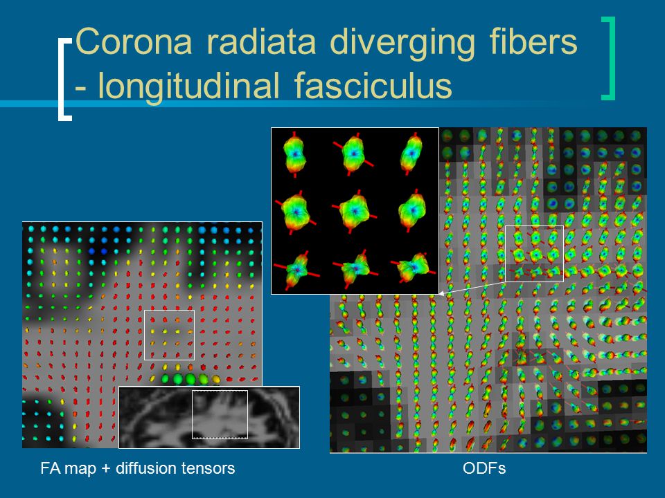 Corona radiata diverging fibers - longitudinal fasciculus