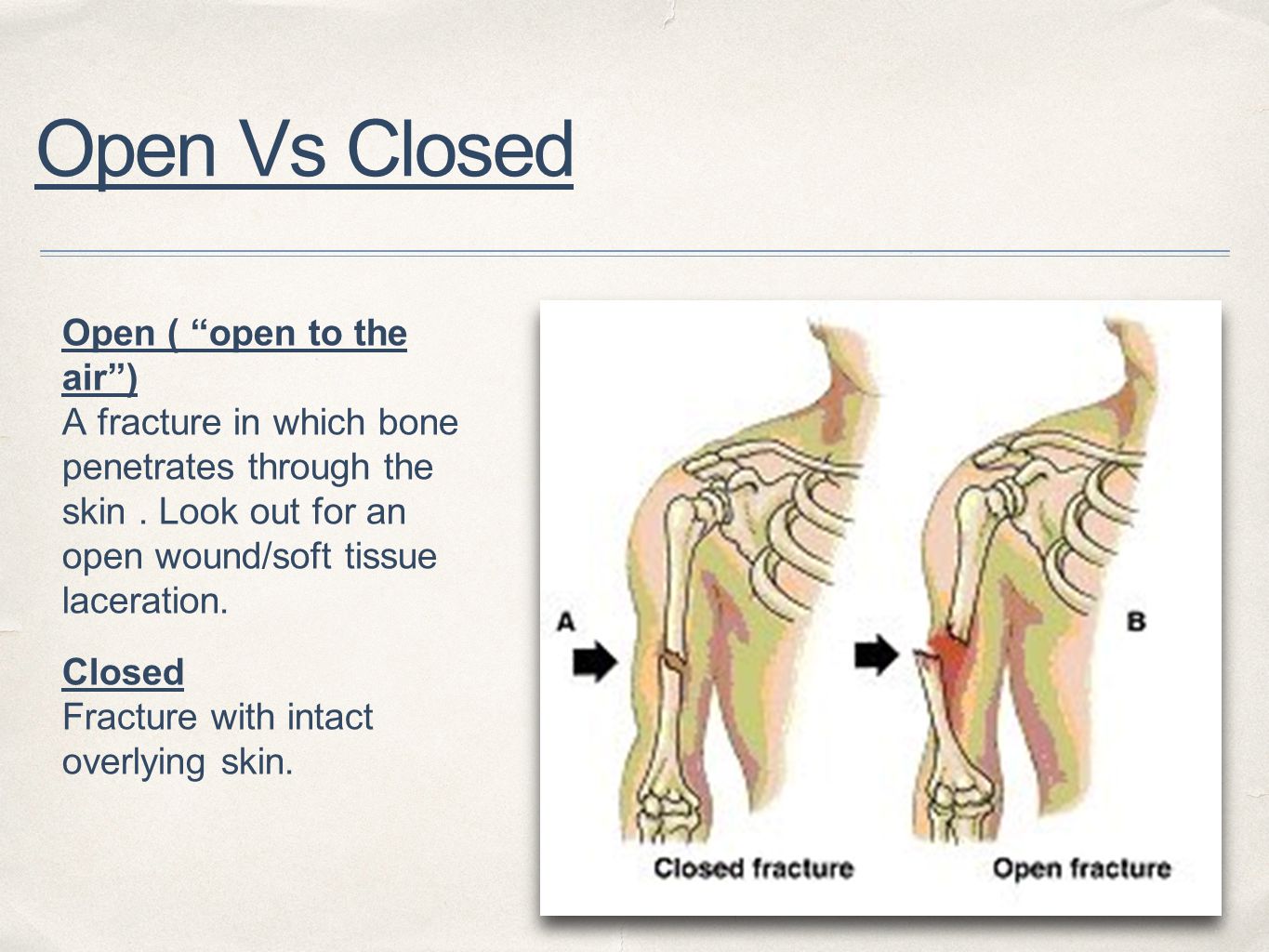 Open vs closed fracture