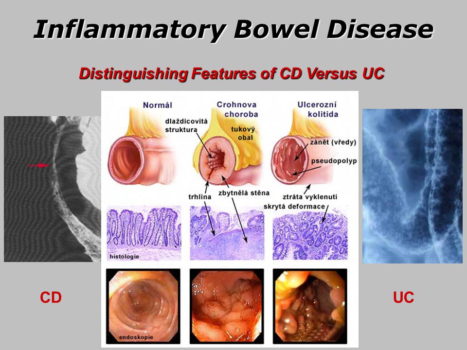 Inflammatory Bowel Disease.