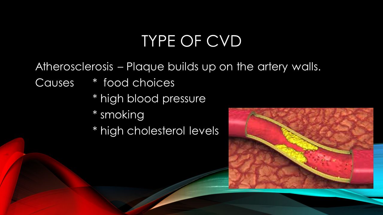 Type of CVD Atherosclerosis – Plaque builds up on the artery walls.