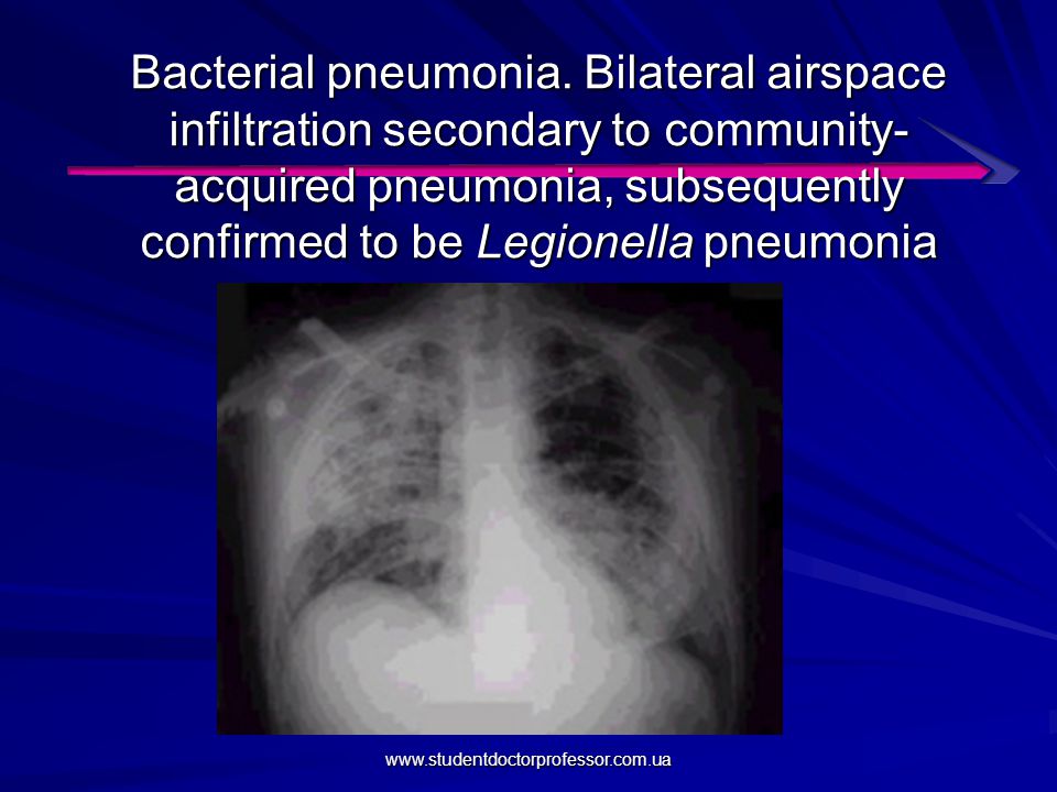 Pneumonia Ppt Video Online Download