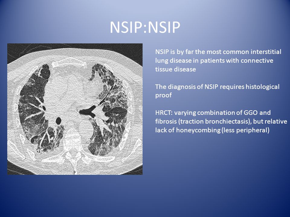 Diffuse Parynchmal Lung Disease How To Approach Ppt Video Online Download