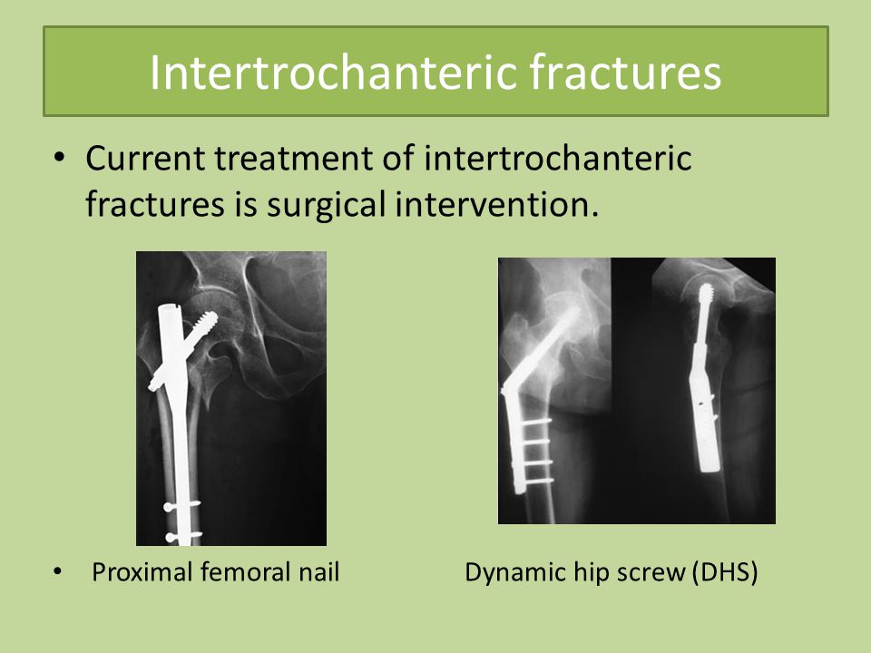 Common lower limb fracture - ppt video online download