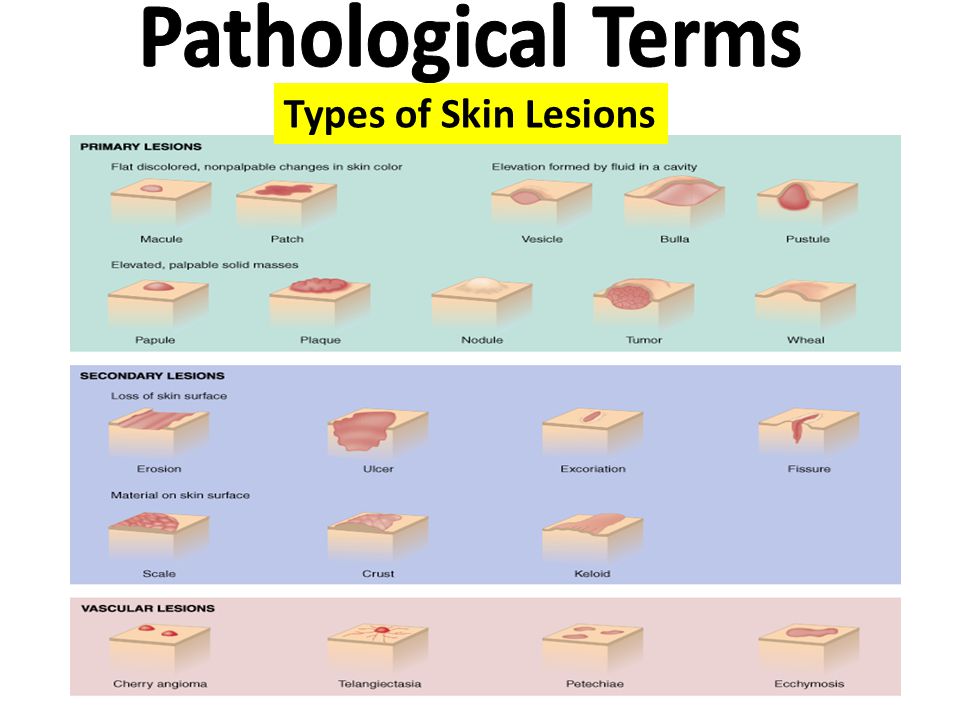 Pathological Terms Primary Lesions Types of Skin Lesions.