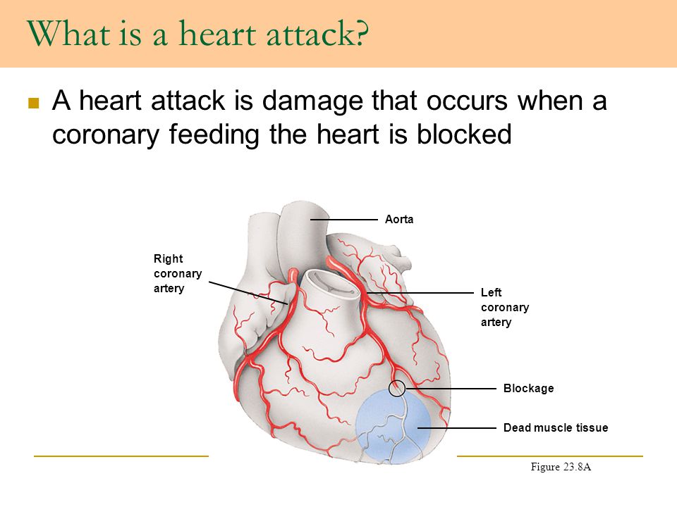 Ms Heart Attack