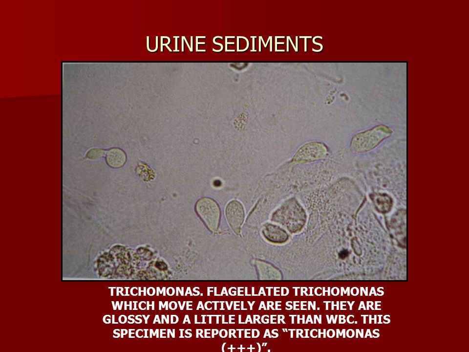 trichomonas in urine sediment