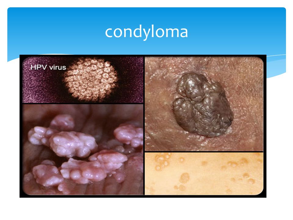 condyloma flukonazol enterobius vermicularis kinder