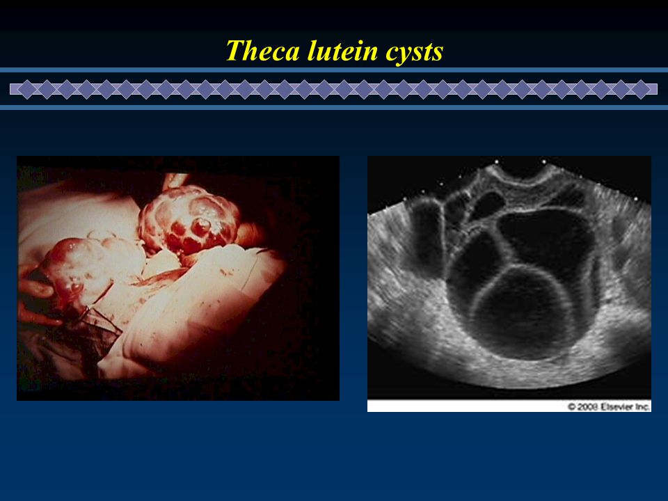 theca luteum cyst