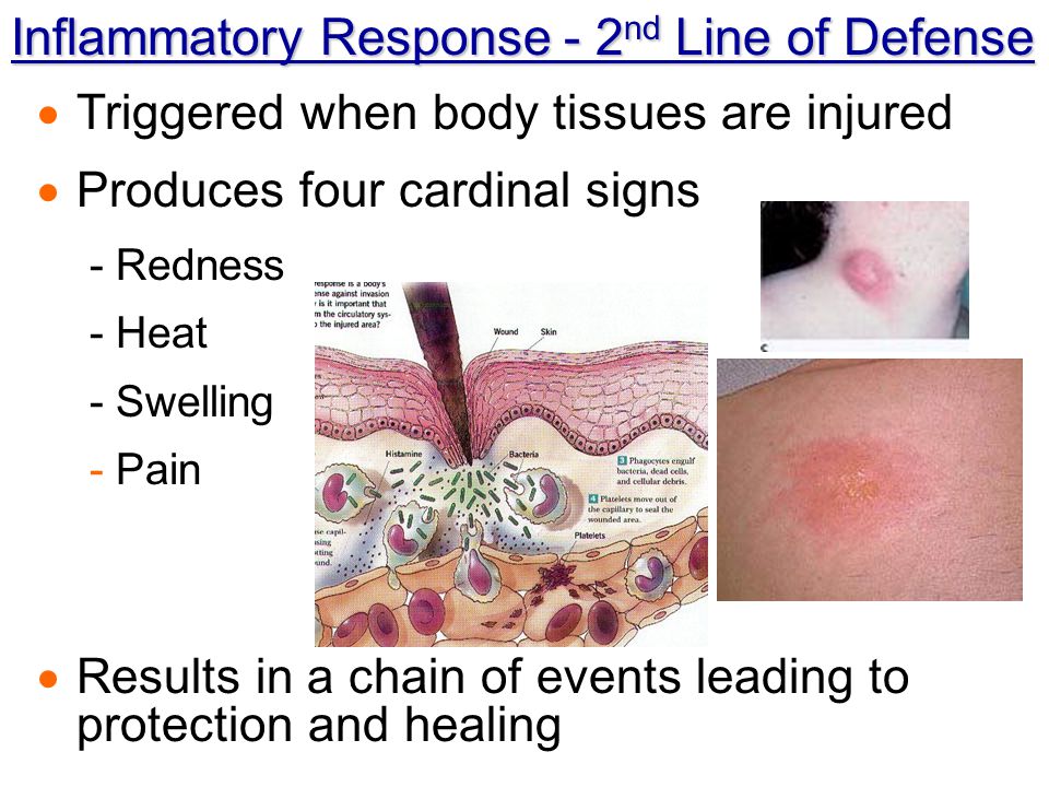 Inflammatory Response - 2nd Line of Defense