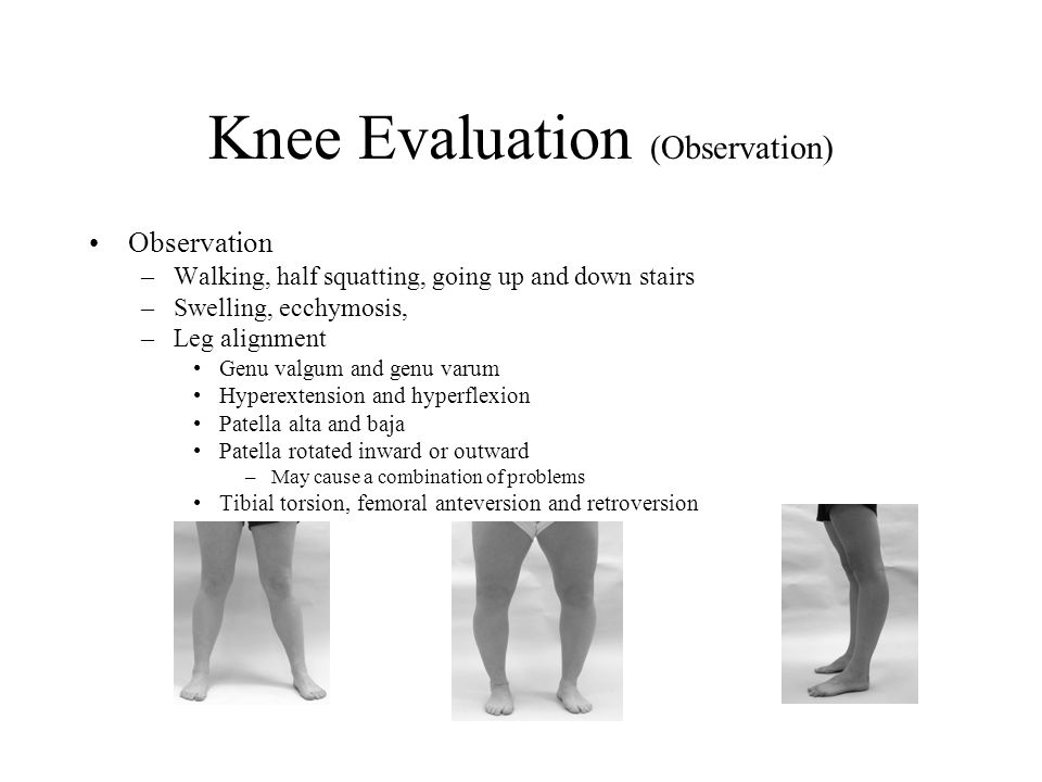 https://slideplayer.com/slide/4771863/15/images/12/Knee+Evaluation+%28Observation%29.jpg