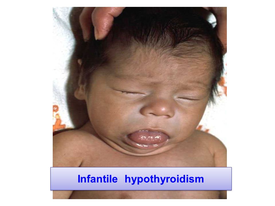 Infantile hypothyroidism