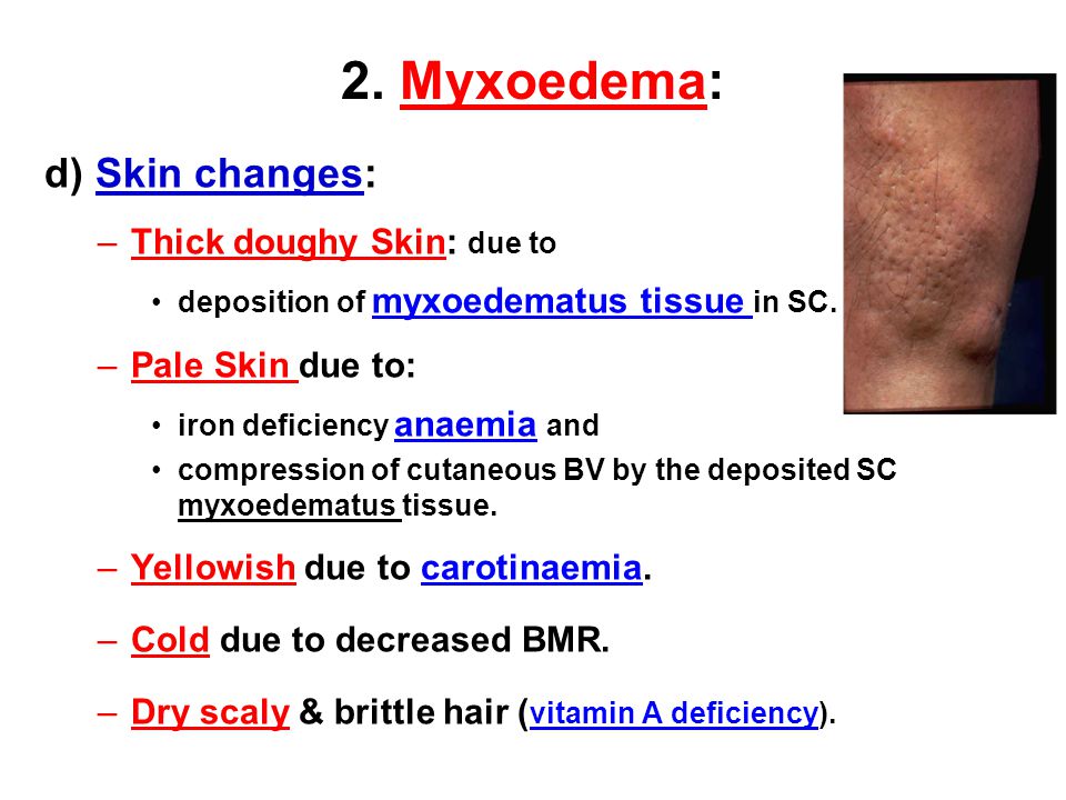 2. Myxoedema: d) Skin changes: Thick doughy Skin: due to