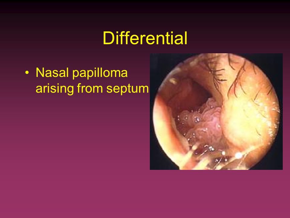Papilloma nasal polyposis