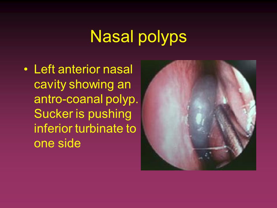 nasal papilloma vs polyp