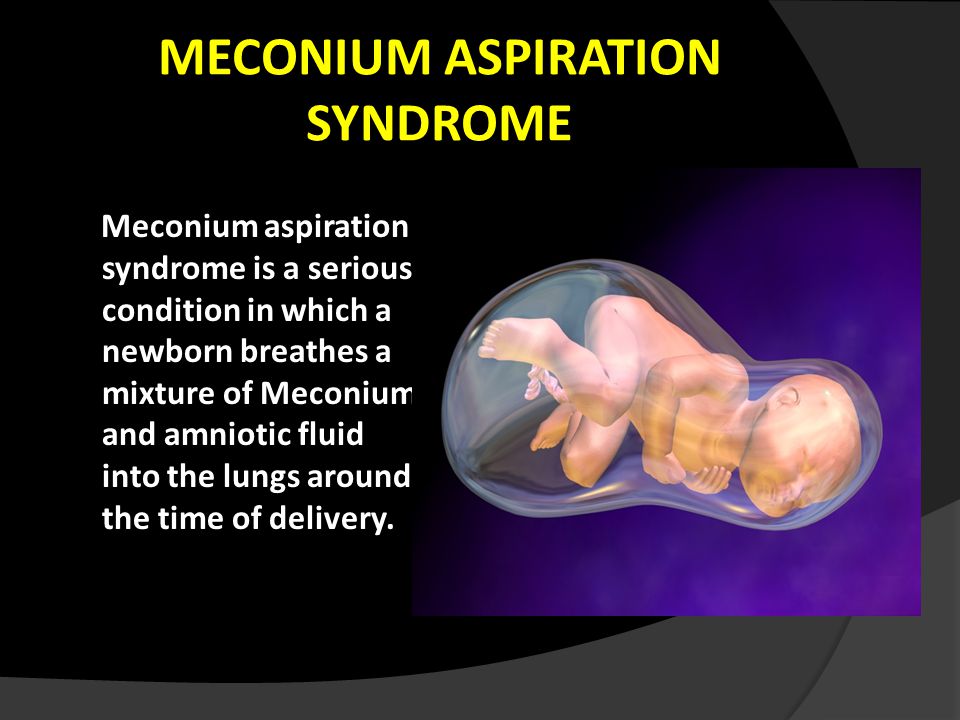MECONIUM ASPIRATION SYNDROME - ppt video online download