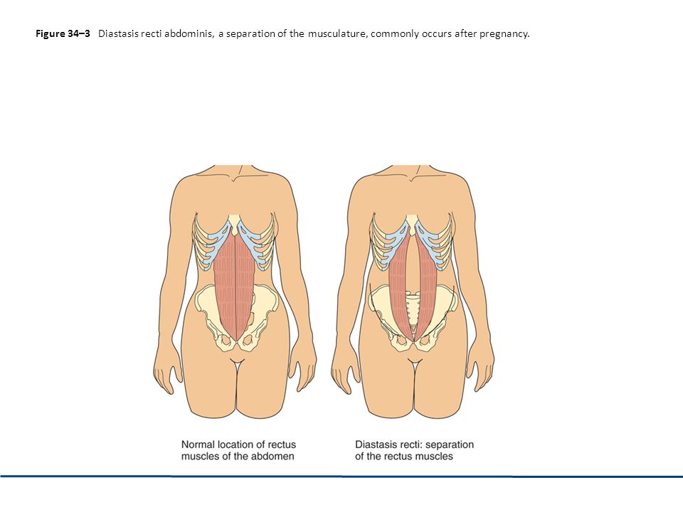 Figure 34–3 Diastasis recti abdominis, a separation of the musculature, commonly occurs after pregnancy.